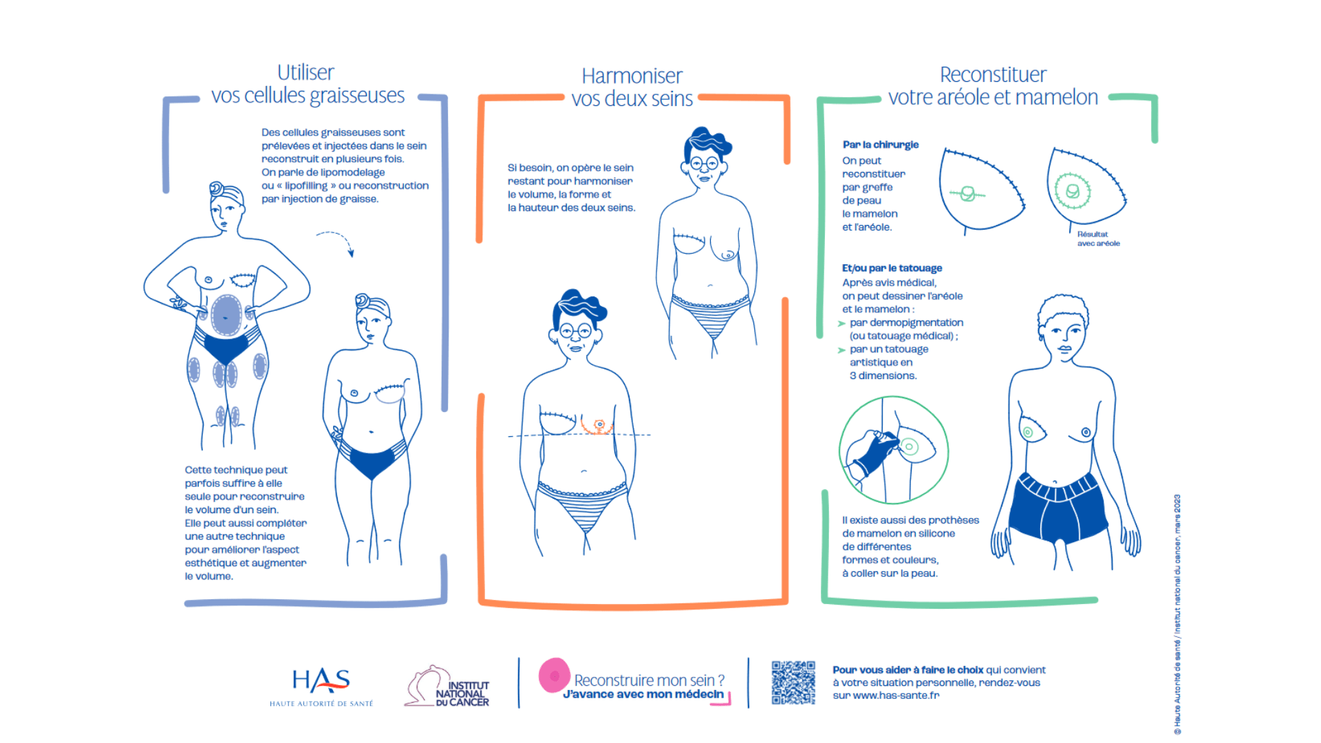 Illustration montrant les différentes techniques: prothèse, utilisation de vos propres tissus dans microchirurgie , utilisation de vos propres tissus avec microchirurgie